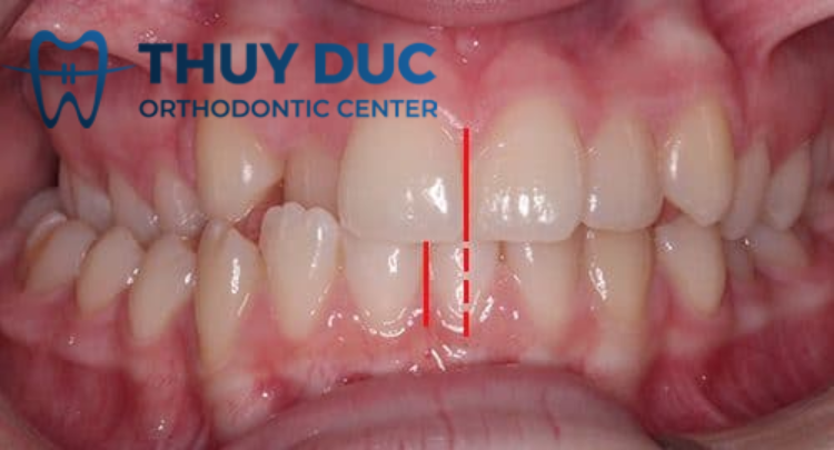 Tác dụng của nâng khớp cắn trong niềng răng 2 Tác dụng của nâng khớp cắn trong niềng răng 2