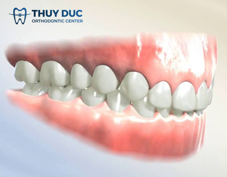 Tác dụng của nâng khớp cắn trong niềng răng 1 Tác dụng của nâng khớp cắn trong niềng răng 1