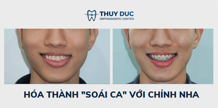 Hình ảnh trước – sau niềng răng với răng khấp khểnh 1 Hình ảnh trước – sau niềng răng với răng khấp khểnh 1