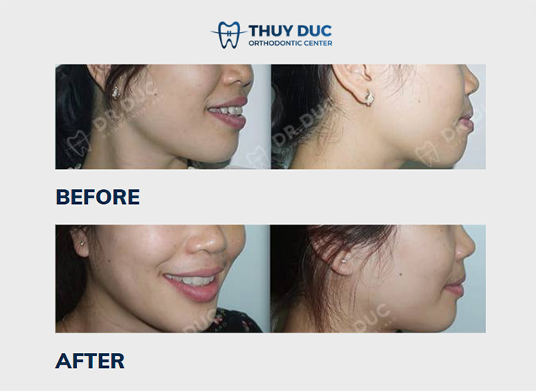 Hình ảnh thay đổi trước và sau khi niềng răng hô tại Nha khoa Thúy Đức 7