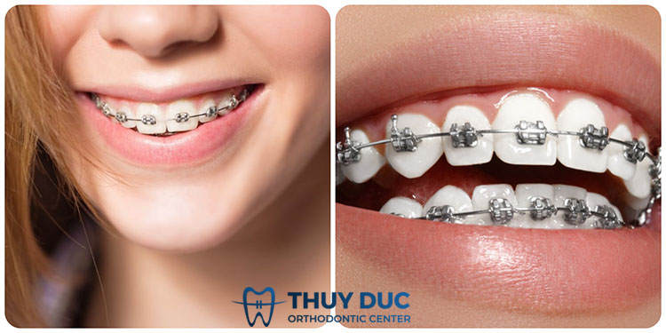 Mắc cài kim loại có những dạng nào? 1 Mắc cài kim loại có những dạng nào? 1