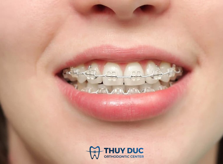 Giải đáp răng yếu có niềng được không 1 Giải đáp răng yếu có niềng được không 1