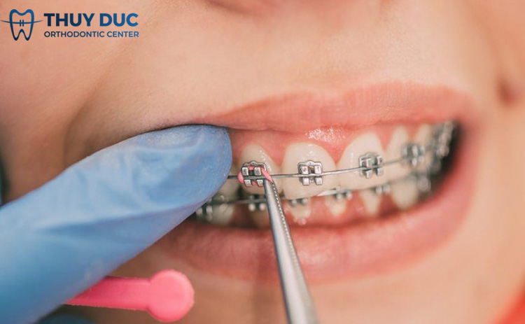 Một số câu hỏi liên quan răng yếu có niềng được không 1 Một số câu hỏi liên quan răng yếu có niềng được không 1