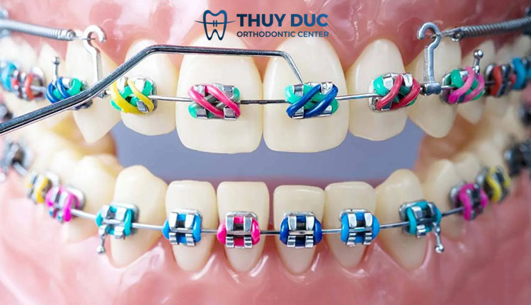 Hiểu rõ về cơ chế niềng răng 1 Hiểu rõ về cơ chế niềng răng 1