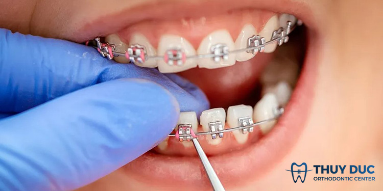 Hiểu rõ về cơ chế niềng răng 2 Hiểu rõ về cơ chế niềng răng 2