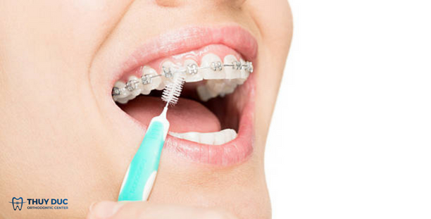 Thực hiện đúng các chỉ định của bác sĩ sau khi niềng răng 1 Thực hiện đúng các chỉ định của bác sĩ sau khi niềng răng 1