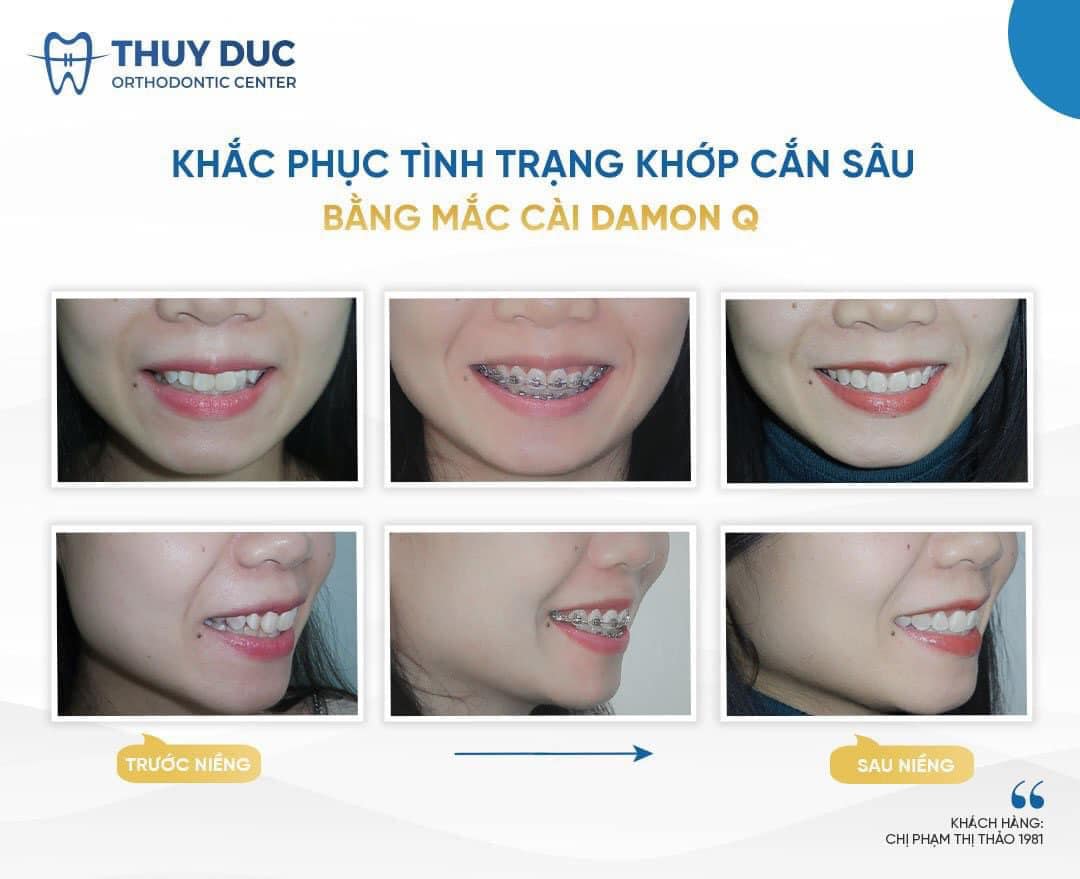 Niềng răng thay đổi góc nghiêng có đúng không? 1