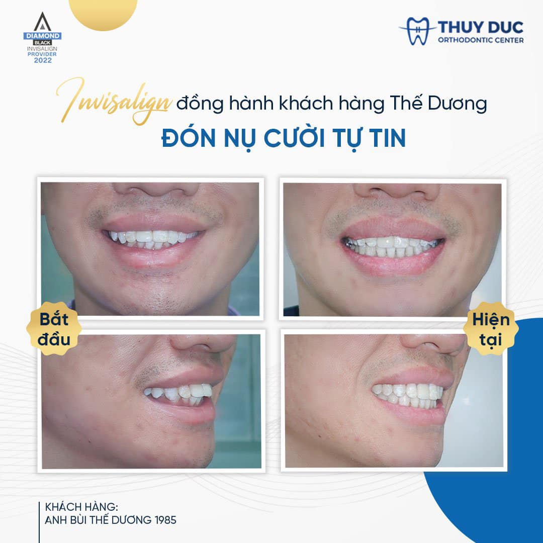 Niềng răng có cải thiện được mặt lệch hay không? 2 Niềng răng có cải thiện được mặt lệch hay không? 2