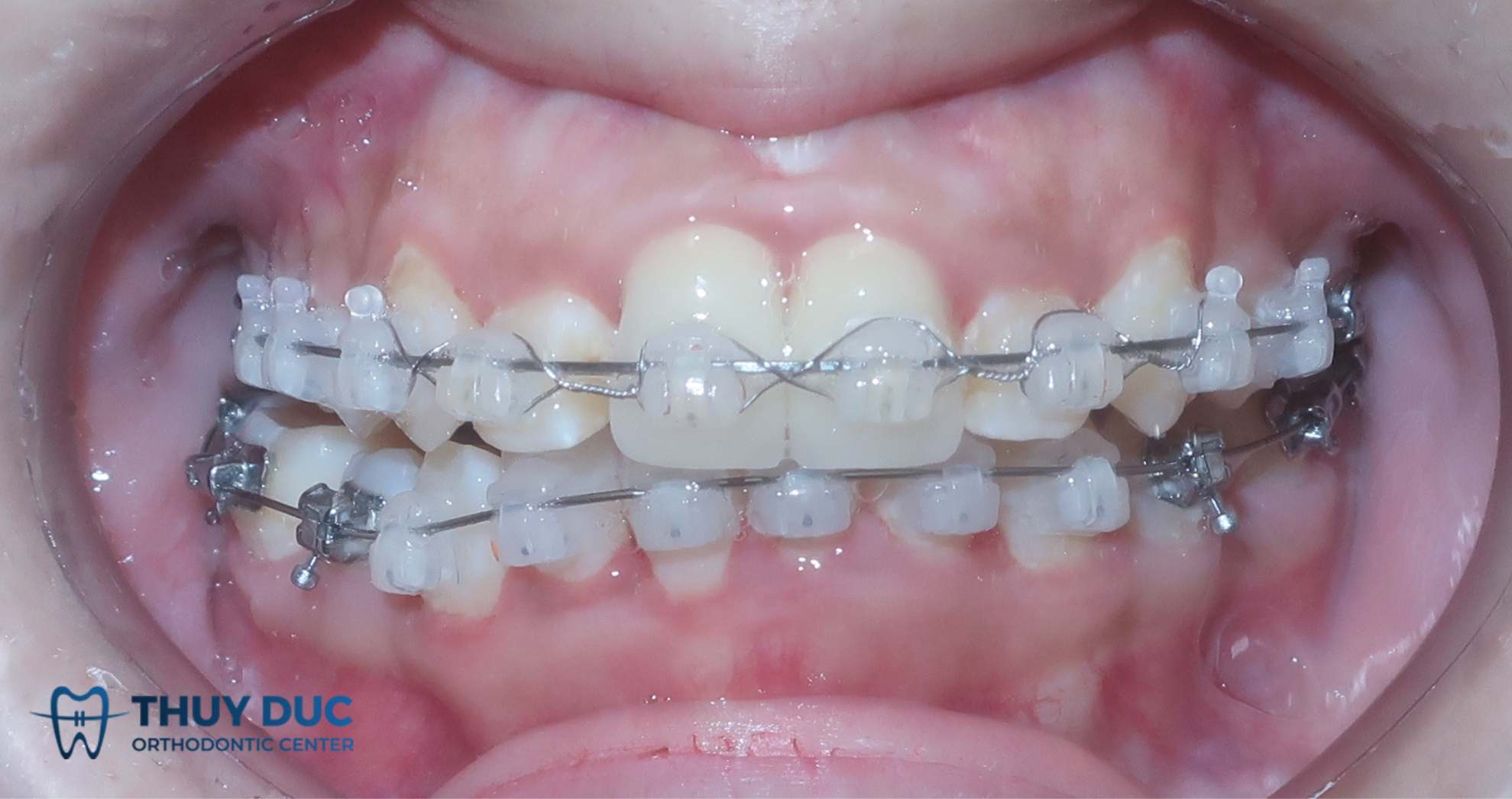 Tiến trình dịch chuyển răng khi niềng? 1
