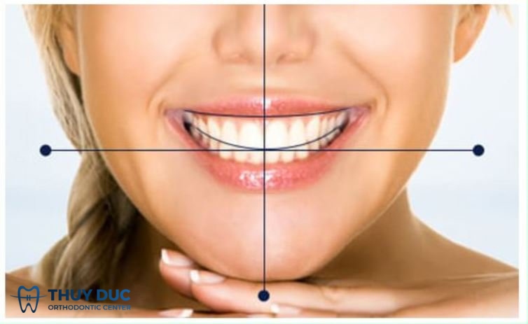 Đường giữa hàm trùng với đường giữa của mặt 1 Đường giữa hàm trùng với đường giữa của mặt 1