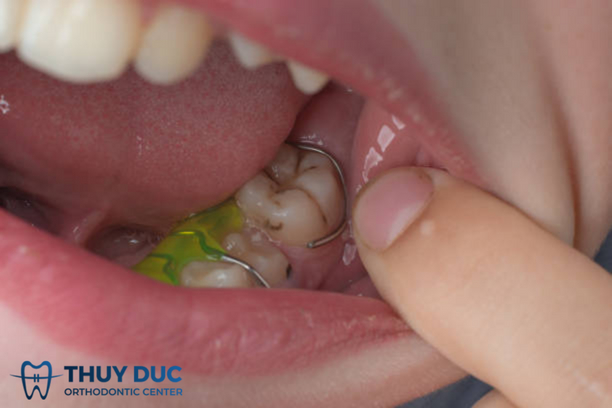 Bị lợi trùm khi niềng răng phải làm như thế nào? 1 Bị lợi trùm khi niềng răng phải làm như thế nào? 1