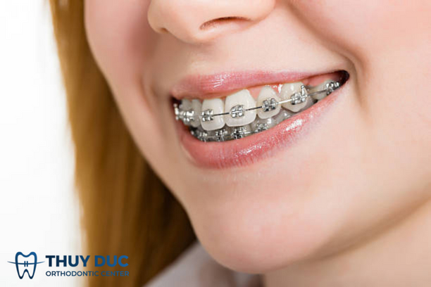Răng đã trám có niềng được không? 2 Răng đã trám có niềng được không? 2