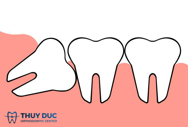Do răng khôn mọc lệch 1 Do răng khôn mọc lệch 1