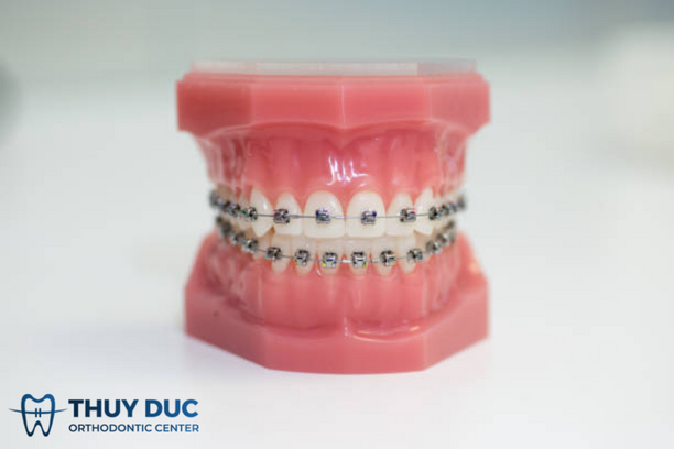 20 tuổi niềng răng có hiệu quả không? 1 20 tuổi niềng răng có hiệu quả không? 1