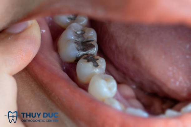 Đối với trường hợp sâu nhẹ 1