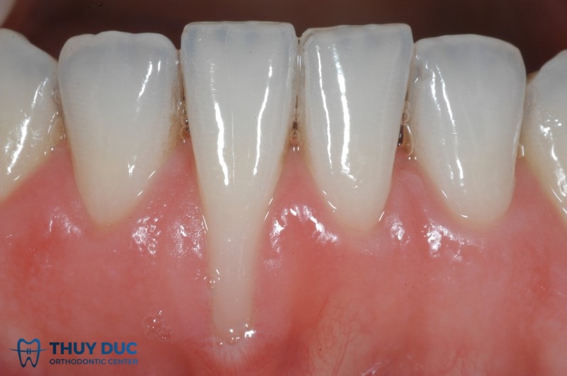 Tụt lợi là gì? Biểu hiện của tụt lợi 1