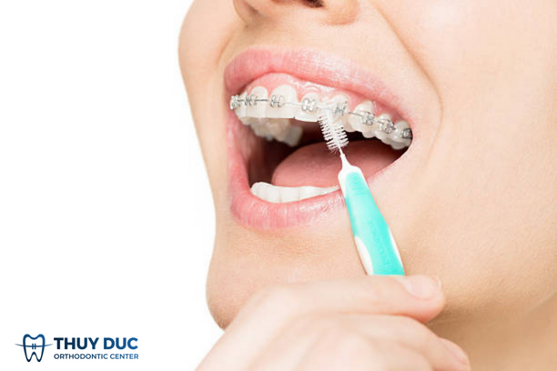 Mảng bám cao răng 1