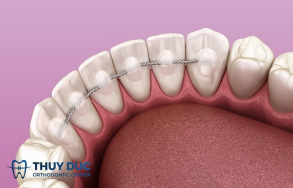 Hàm duy trì tháo lắp 3
