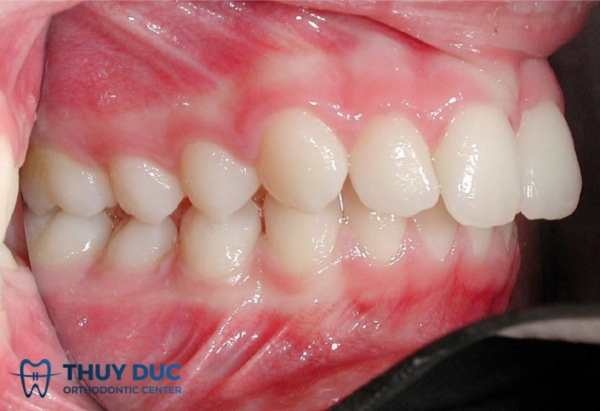 Hô răng 1 Hô răng 1