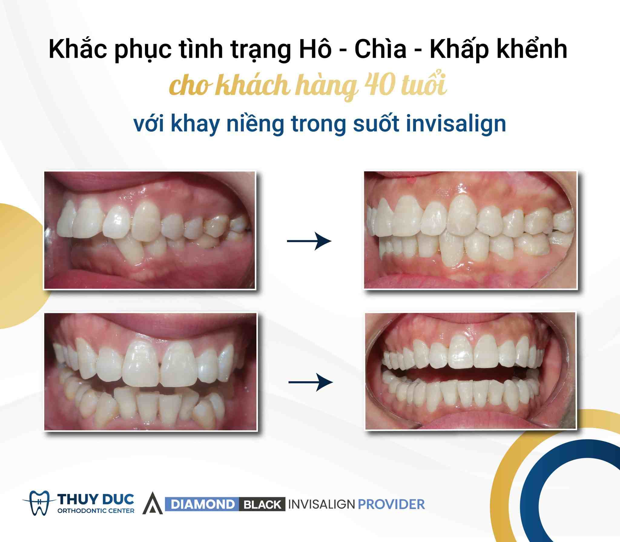Invisalign - Giải pháp niềng răng hiệu quả cho người 40 tuổi 1