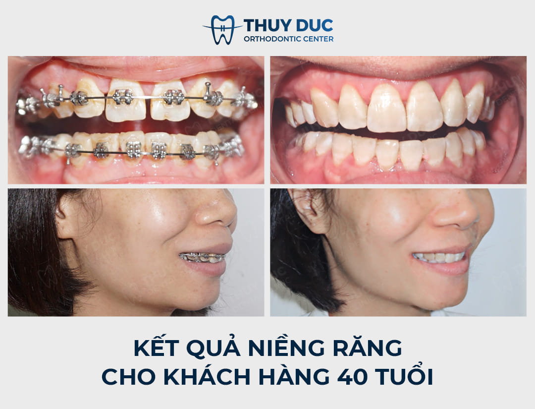 4. Những lưu ý quan trọng khi niềng răng ở độ tuổi 40