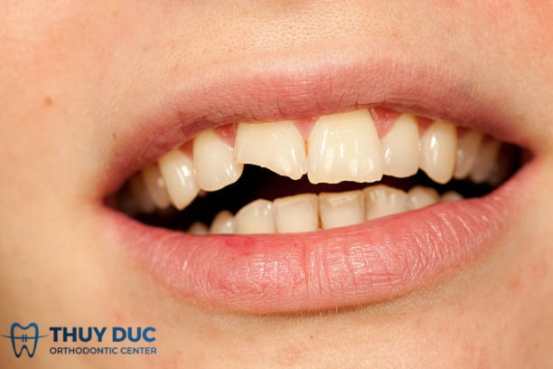 Nguyên nhân dẫn đến việc gãy răng 1 Nguyên nhân dẫn đến việc gãy răng 1