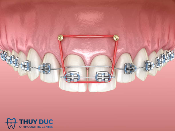 Cắm vít niềng răng bị sưng viêm - Nguyên nhân và cách khắc phục 1 Cắm vít niềng răng bị sưng viêm - Nguyên nhân và cách khắc phục 1