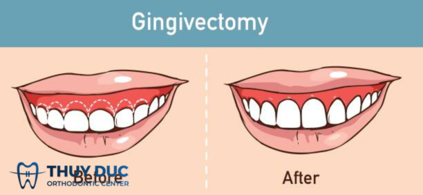 Có nên cắt lợi sau niềng răng hay không? 1 Có nên cắt lợi sau niềng răng hay không? 1