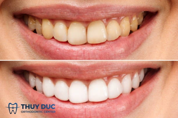 Có nên tẩy trắng răng trước khi niềng răng không? 1 Có nên tẩy trắng răng trước khi niềng răng không? 1