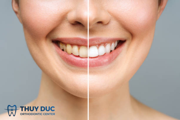 Có nên tẩy trắng răng trước khi niềng không? 1 Có nên tẩy trắng răng trước khi niềng không? 1