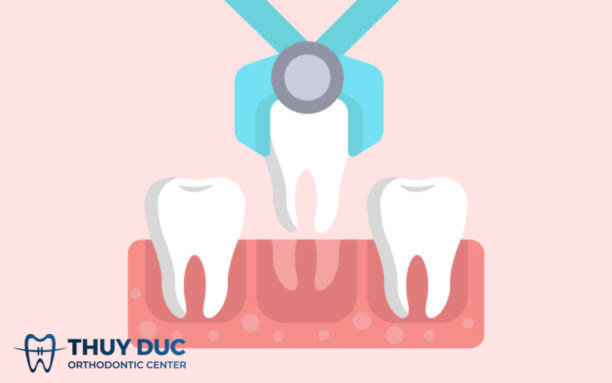 Gắn mắc cài trước hay sau khi nhổ răng? 1 Gắn mắc cài trước hay sau khi nhổ răng? 1