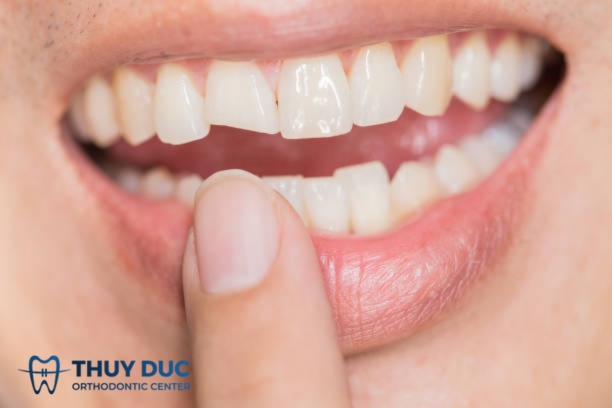 Bị gãy răng có niềng được không? 1 Bị gãy răng có niềng được không? 1