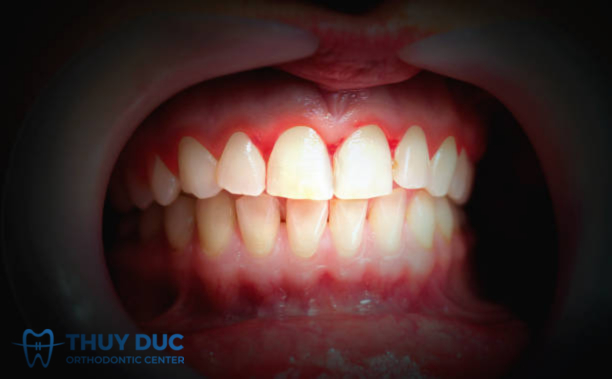 Do bệnh lý răng miệng và thói quen chăm sóc răng miệng 1 Do bệnh lý răng miệng và thói quen chăm sóc răng miệng 1