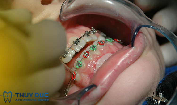 Mỏi hàm do xương hàm 1 Mỏi hàm do xương hàm 1