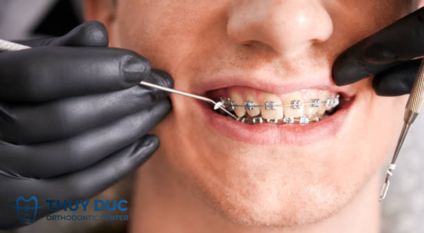 Nuốt dây thun niềng răng có sao không? 1 Nuốt dây thun niềng răng có sao không? 1