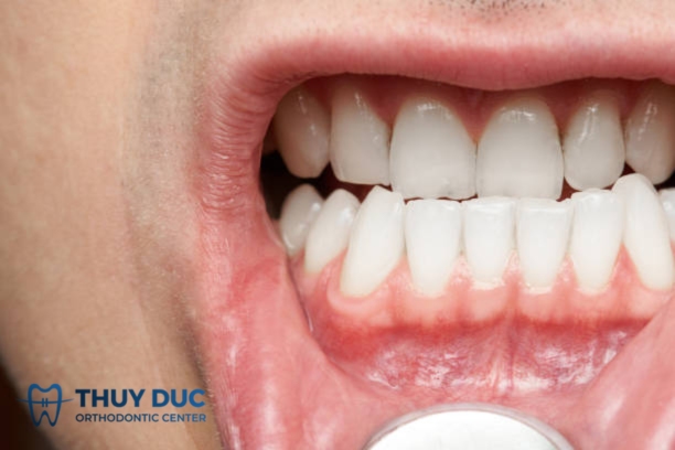 Tướng răng cửa thụt vào trong 1
