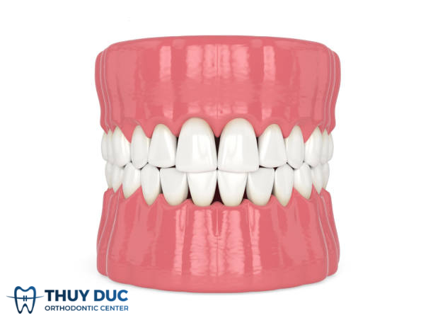Tam giác đen khi niềng răng - Nguyên nhân và cách khắc phục 1 Tam giác đen khi niềng răng - Nguyên nhân và cách khắc phục 1