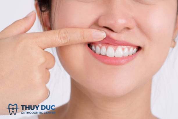 Tam giác đen ở răng có thể gây ra những vấn đề sức khỏe khác không?
