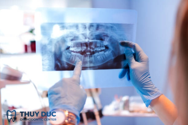 Những lưu ý khi chụp X - quang răng? 1 Những lưu ý khi chụp X - quang răng? 1