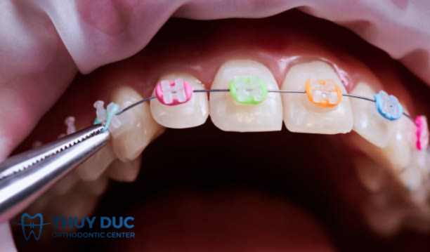 Không tự ý tháo lắp thun 1 Không tự ý tháo lắp thun 1