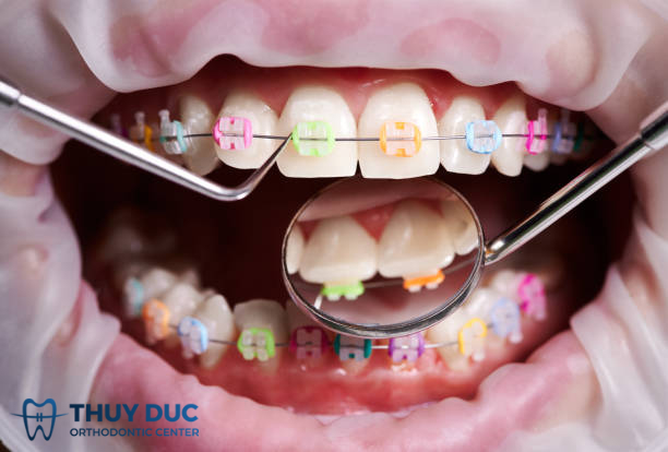 Nuốt dây thun niềng răng có sao không? 1 Nuốt dây thun niềng răng có sao không? 1
