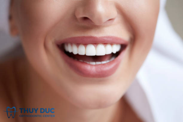 Veneer, răng sứ 1 Veneer, răng sứ 1