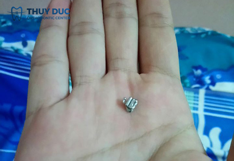 Nguyên nhân khiến mắc cài bị rơi 1