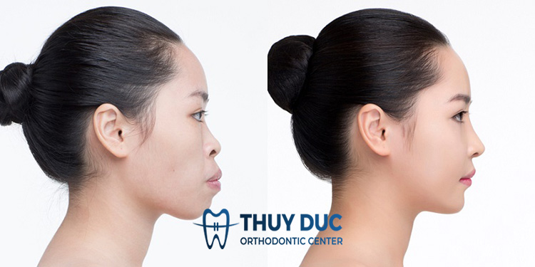 Niềng răng 1 Niềng răng 1