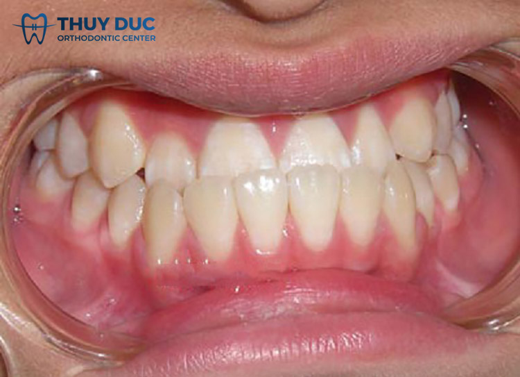 Răng móm là gì? Điều trị răng móm như thế nào? 1