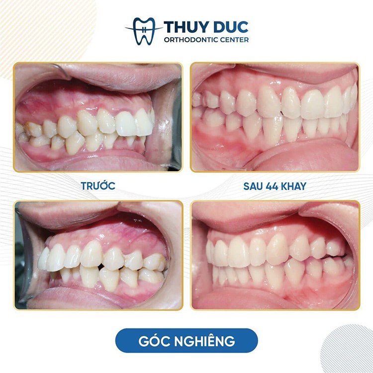 Giới thiệu địa chỉ niềng răng uy tín tại Hà Nội 4