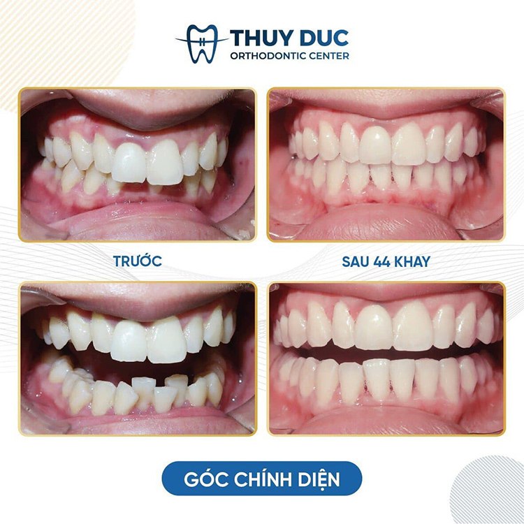Giới thiệu địa chỉ niềng răng uy tín tại Hà Nội 3