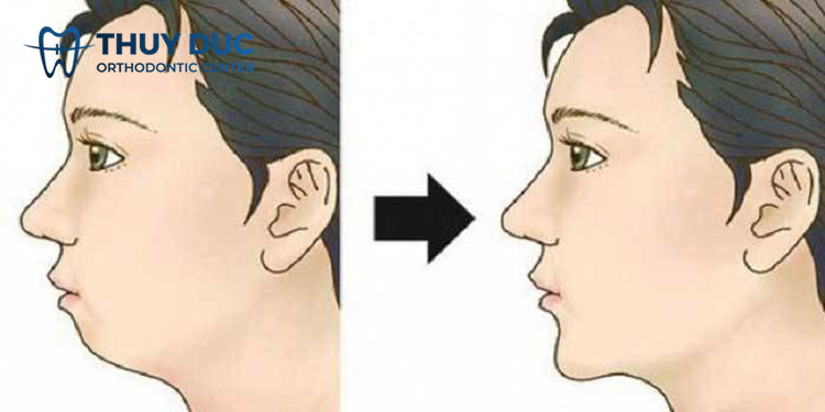 Phẫu thuật cằm 1 Phẫu thuật cằm 1