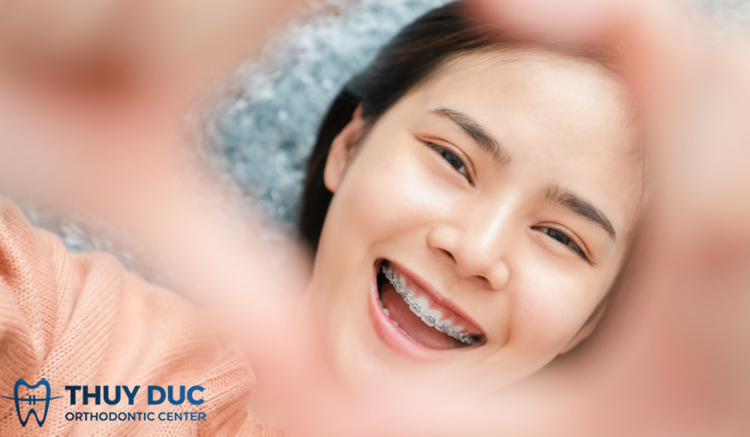 Phương pháp niềng răng 1 Phương pháp niềng răng 1