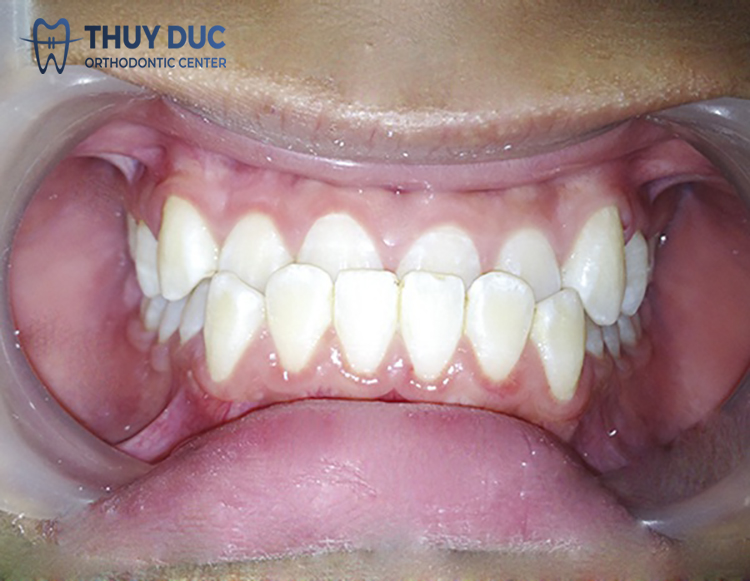 Ảnh hưởng đến tướng số 1